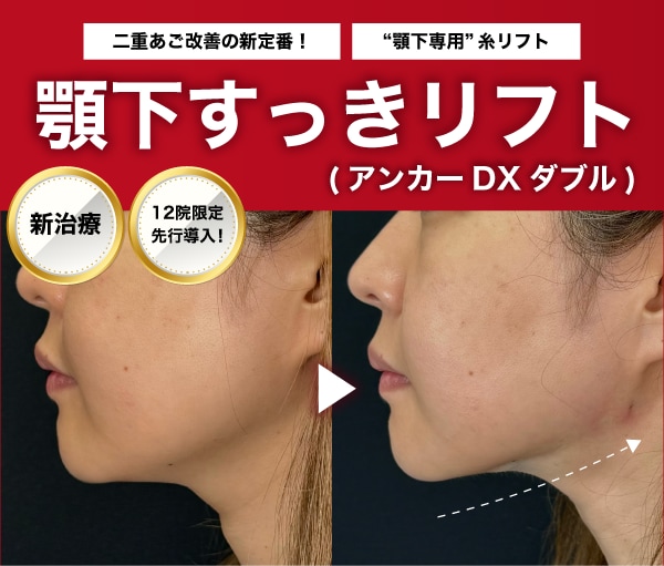 【新治療登場】二重あご・たるみにサヨナラ！「顎下すっきリフト」で叶える、誰もが羨むシャープな横顔