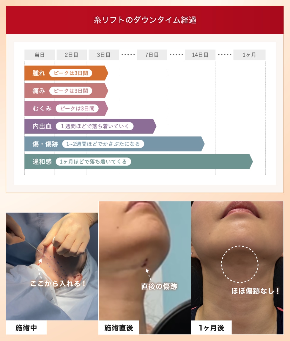 ダウンタイム・リスク