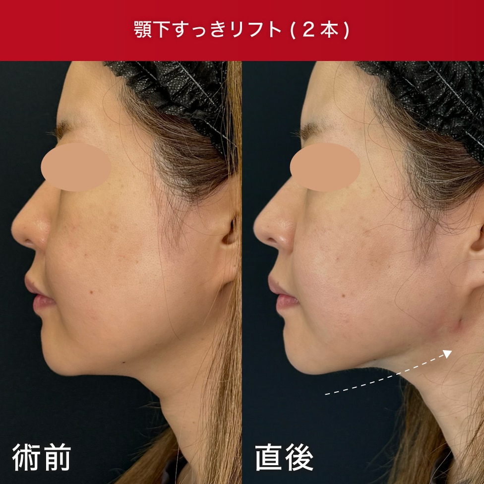 顎下にピッタリくっつく！