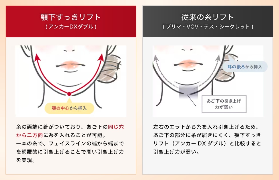 従来の糸リフトとの違い