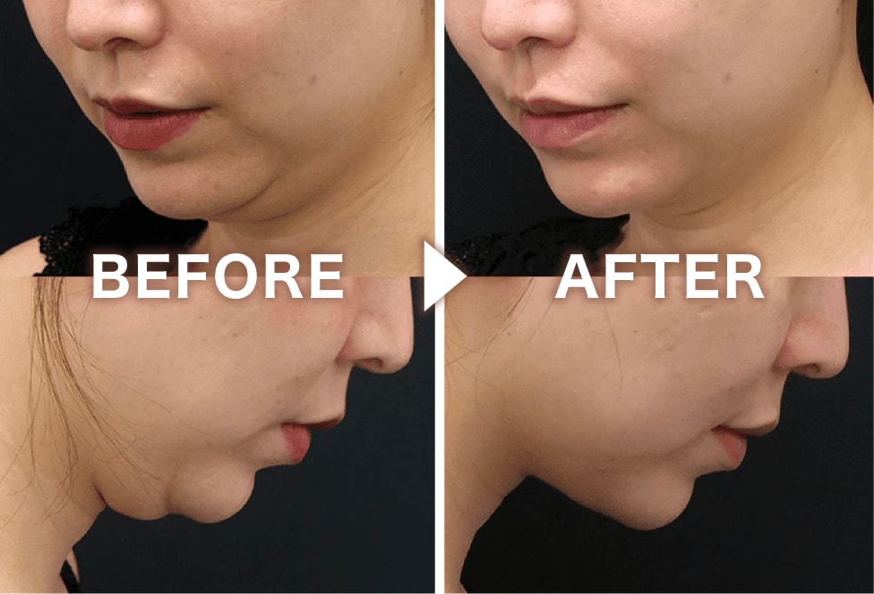 顎下に特化した糸リフト！