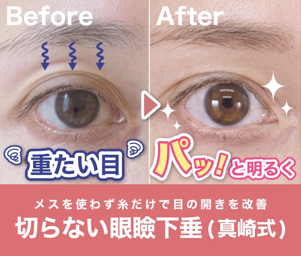 切らない眼瞼下垂とは?目の開けづらさを解消する最新術式を徹底解説|湘南美容クリニック千葉センシティ院