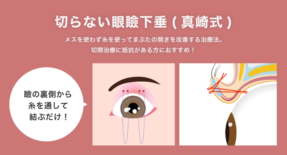 メスを使わず行う治療法！