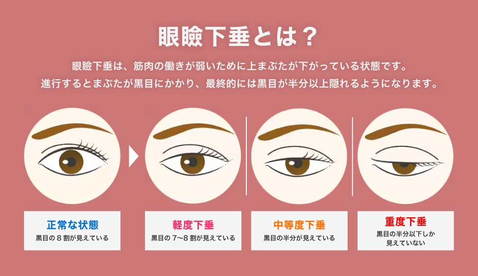眼瞼下垂とは？