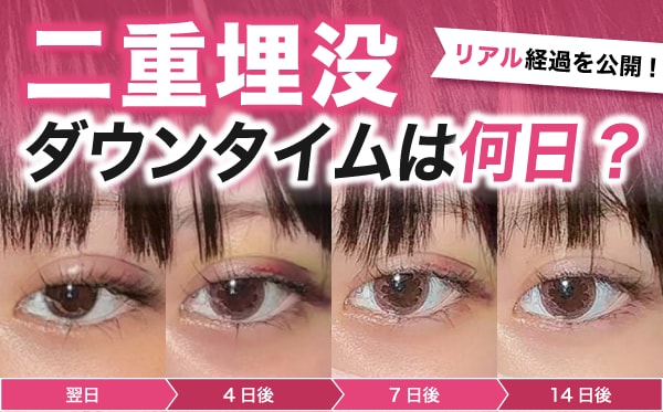 【写真で見る】二重埋没のダウンタイムは何日？術後の経過を症例写真で徹底解説｜千葉センシティ院