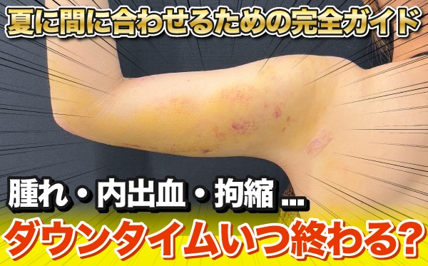 脂肪吸引のダウンタイムはいつ終わる？