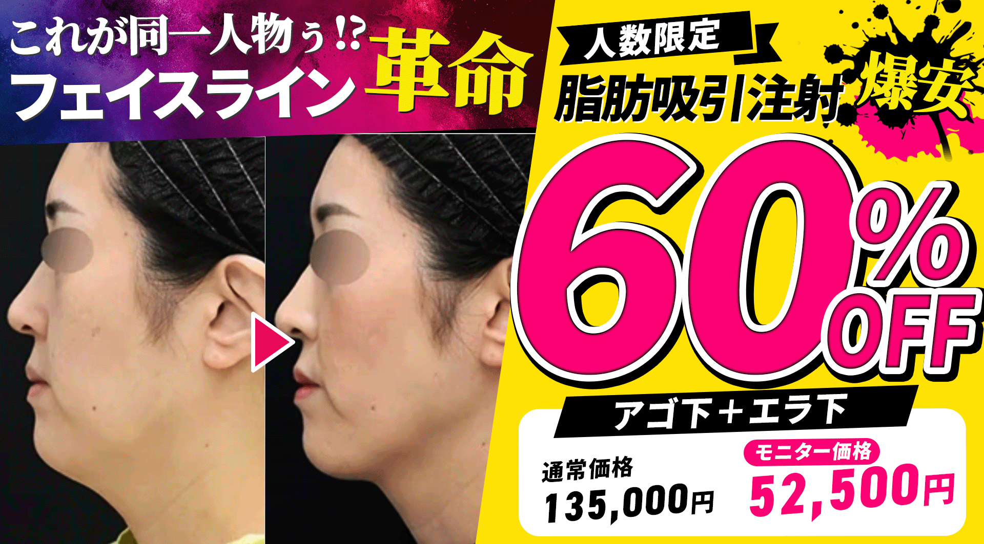 早い者勝ち👊脂肪吸引モニター緊急募集