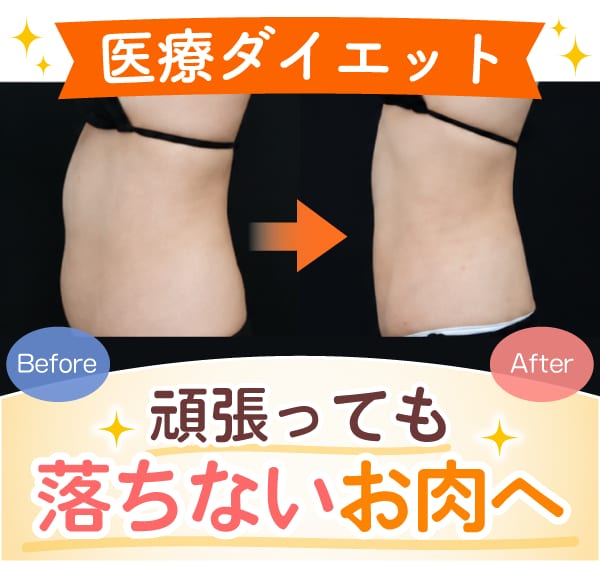 部分痩せはセットで攻める。クルスカ＋山参注射の相乗効果