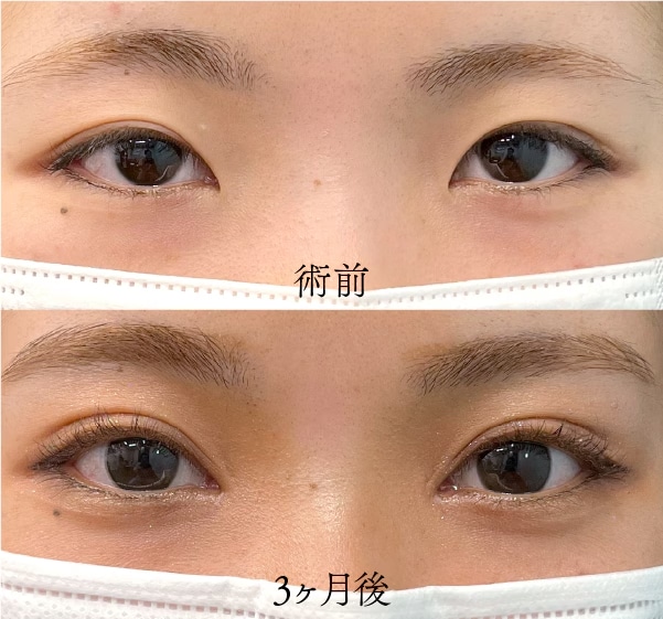 目頭切開とは？
