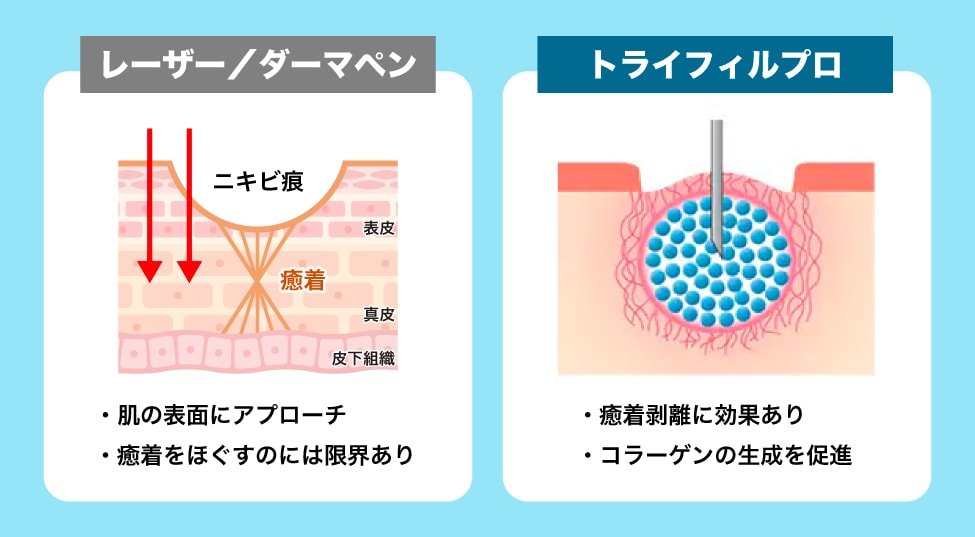 レーザーやダーマペンとは何が違うの？