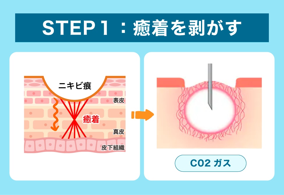 ステップ① はがす――引っ張っている組織をやわらげる