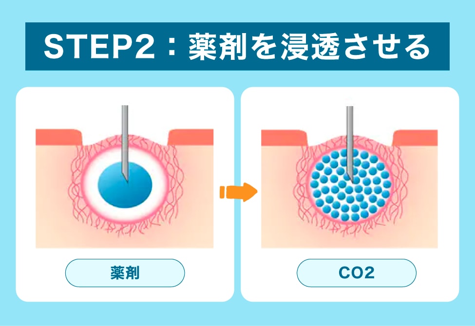 ステップ② 届ける――薬剤をムラなく浸透させる