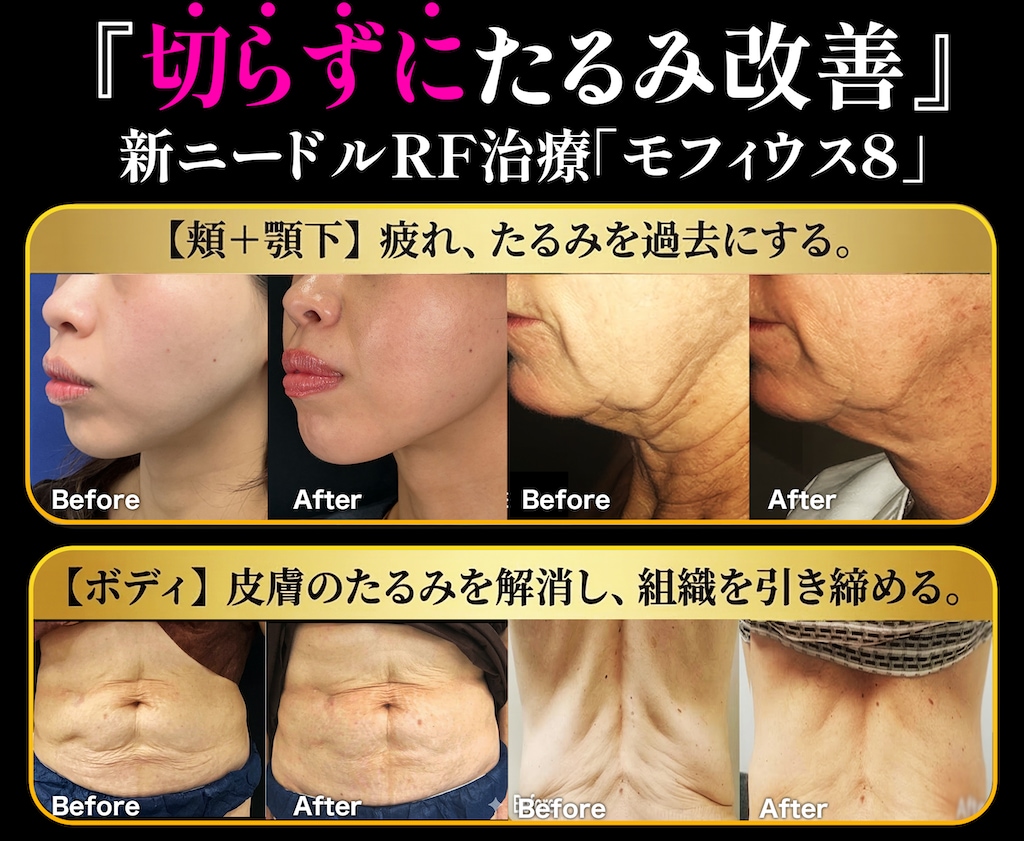 モフィウス8