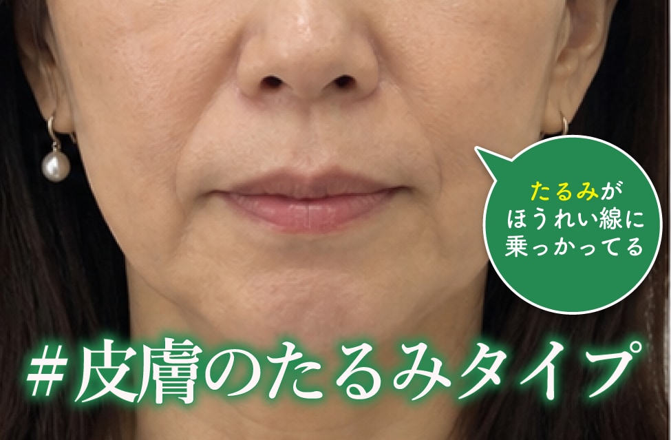 皮膚のたるみタイプ