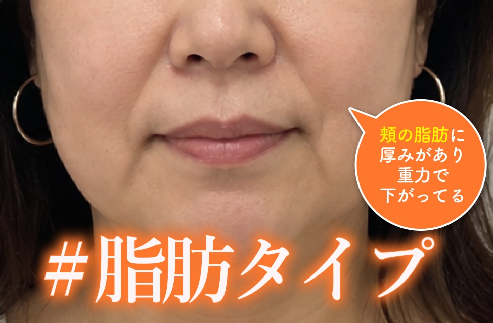 脂肪タイプ