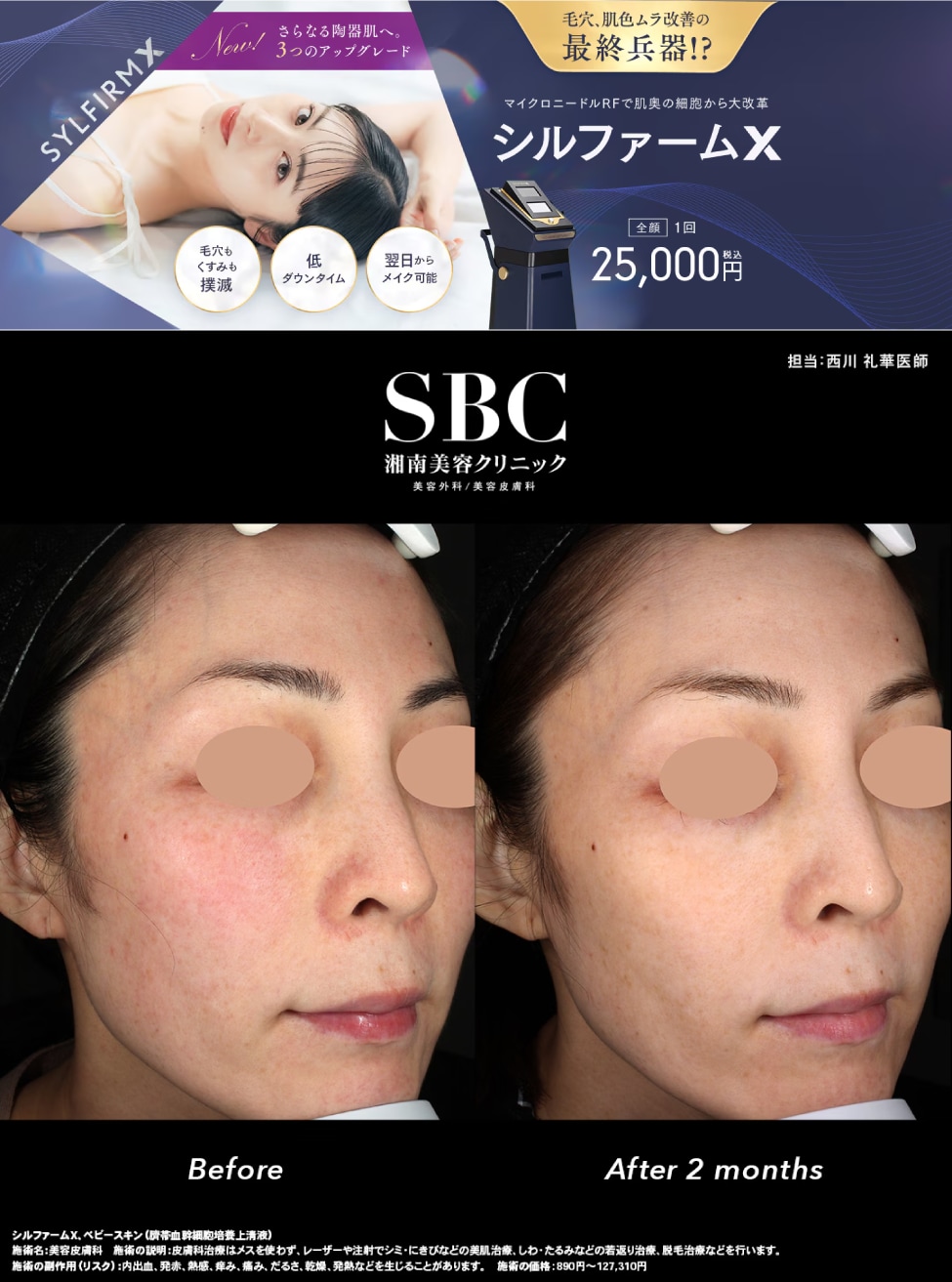 ② 毛穴・肝斑・肌質を整えたいなら「シルファームX」