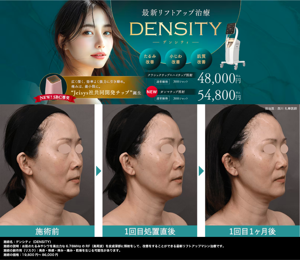 ④ ハリ不足・たるみが気になり始めたら「デンシティ」