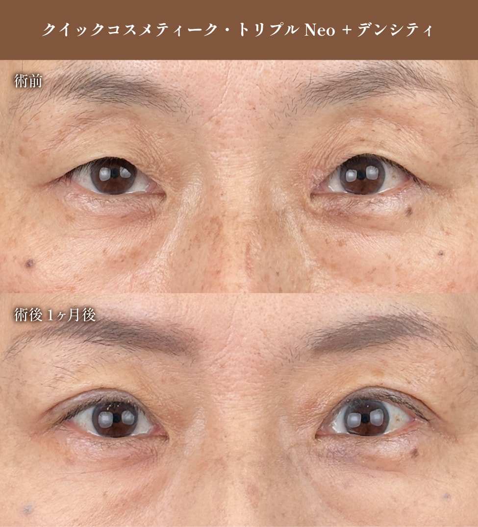 50代：「重たまぶた」の根本改善と上品な若返り
