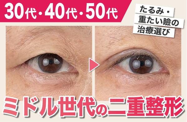 30代・40代・50代の二重整形ガイド｜たるみ改善の症例を解説【SBC千葉センシティ院】