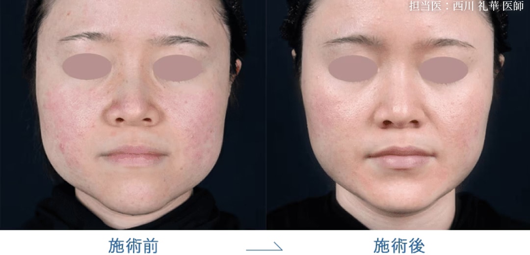 エラボトックスで小顔に｜噛みしめグセのある方にも