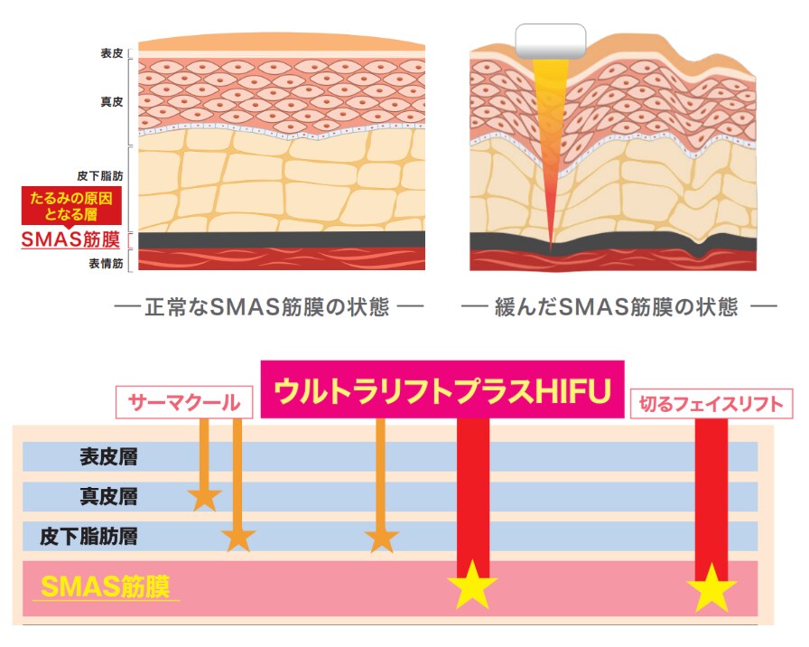 ウルトラリフトプラスHIFU（医療ハイフ）とは？？