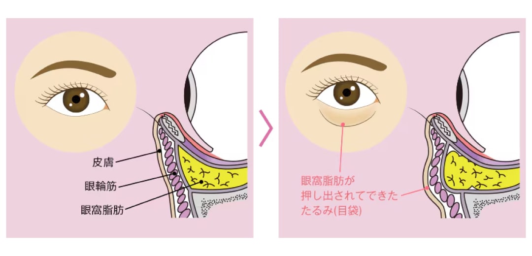 「目の下のクマ・たるみ（ふくらみ）」主な原因