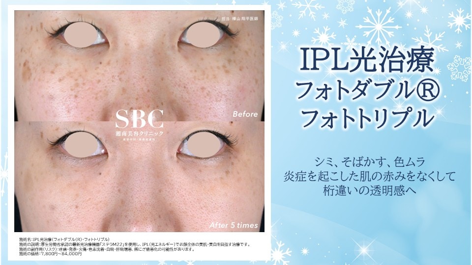 ⭐IPL光治療(フォトダブル®・フォトトリプル)⭐