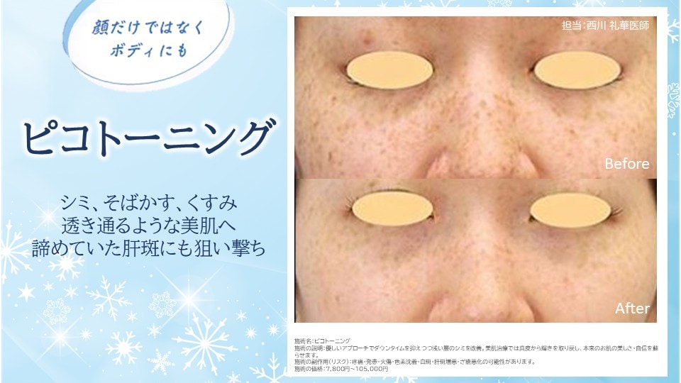 ⭐ピコトーニング⭐