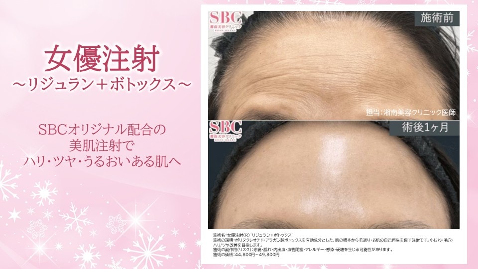 ⭐女優注射®～リジュラン＋ボトックス～⭐