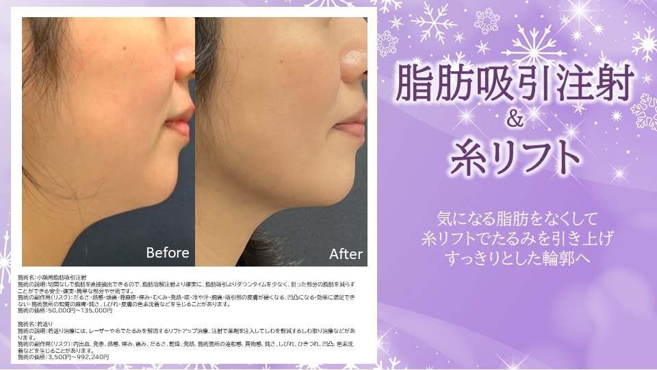 ⭐脂肪吸引注射＋糸リフト⭐<br />
