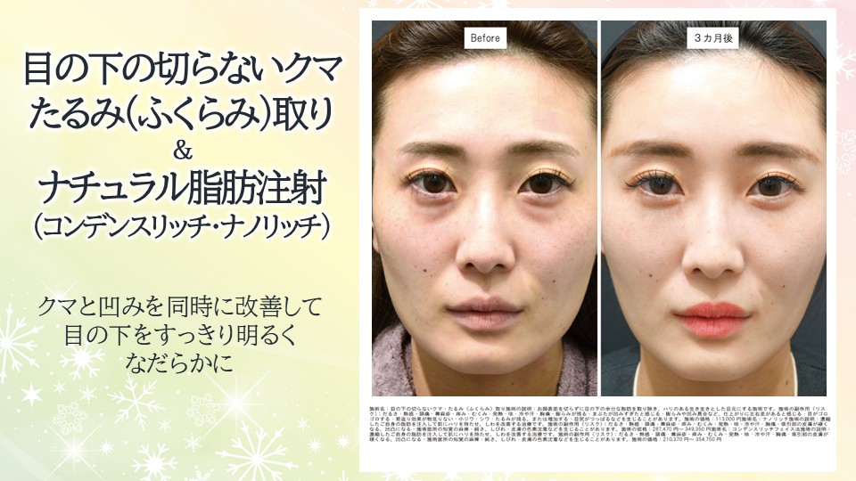 疲れ顔から脱却！<br />
⭐目の下の切らないクマ・たるみ(ふくらみ)取り⭐<br />
⭐ナチュラル脂肪注射(コンデンスリッチ・ナノリッチ)⭐