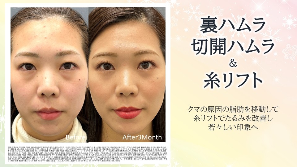 くま取りで若返るならこの組み合わせ！<br />
⭐裏ハムラ/切開ハムラ＋糸リフト⭐