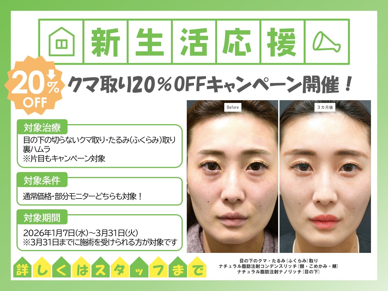 【新生活応援キャンぺーン!クマ取り20%OFF✨】クマ取り治療の基礎知識解説付き