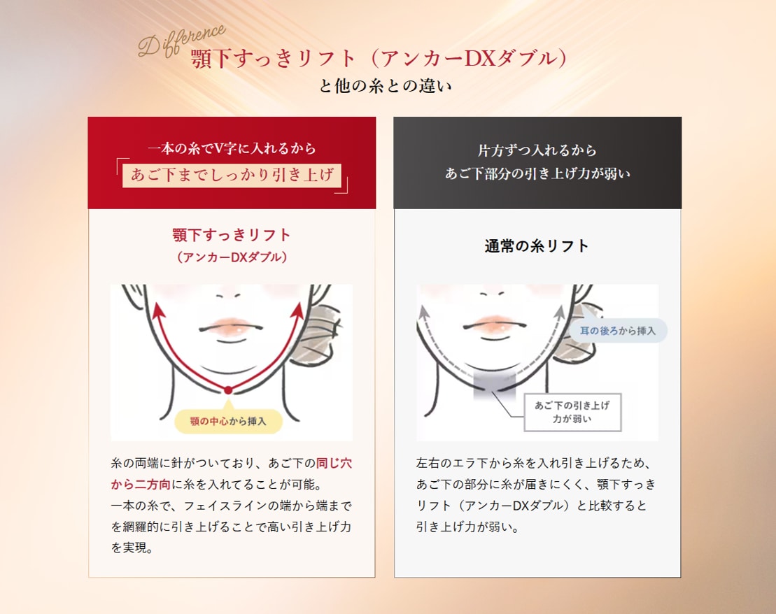 顎下に特化した糸リフト