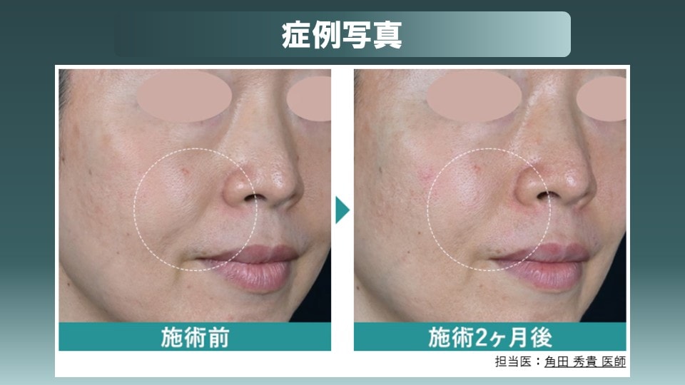 効果は最大で6か月