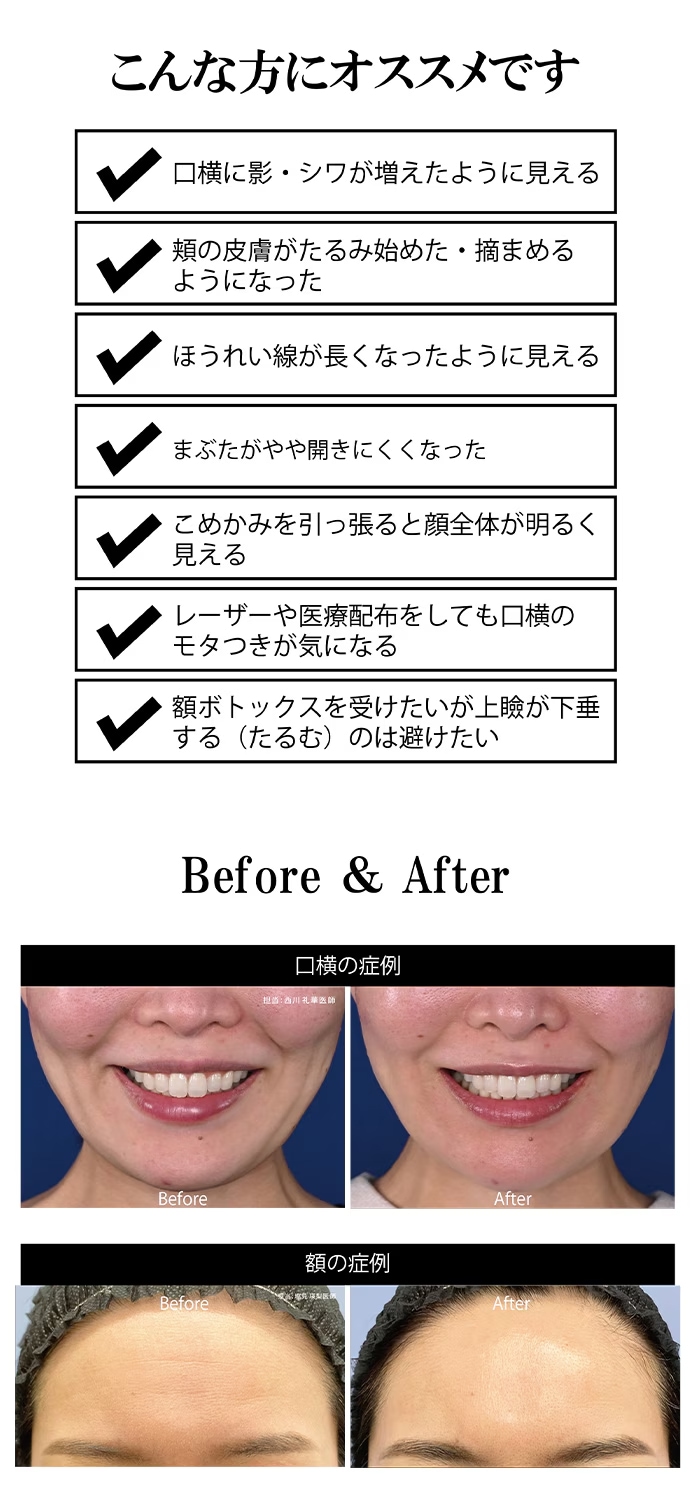 トキシルとは、長期的なしわ改善・皮膚たるみの緩和（肌のタイトニング）を目的とした施術です