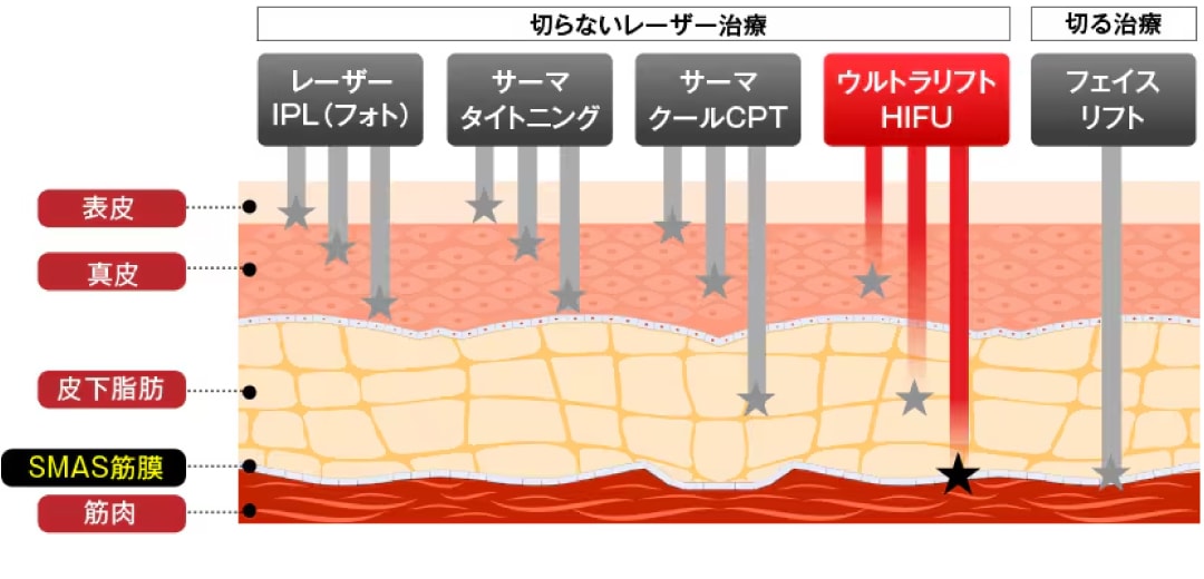 湘南美容クリニックでは様々な切らずにたるみ改善治療をご用意！