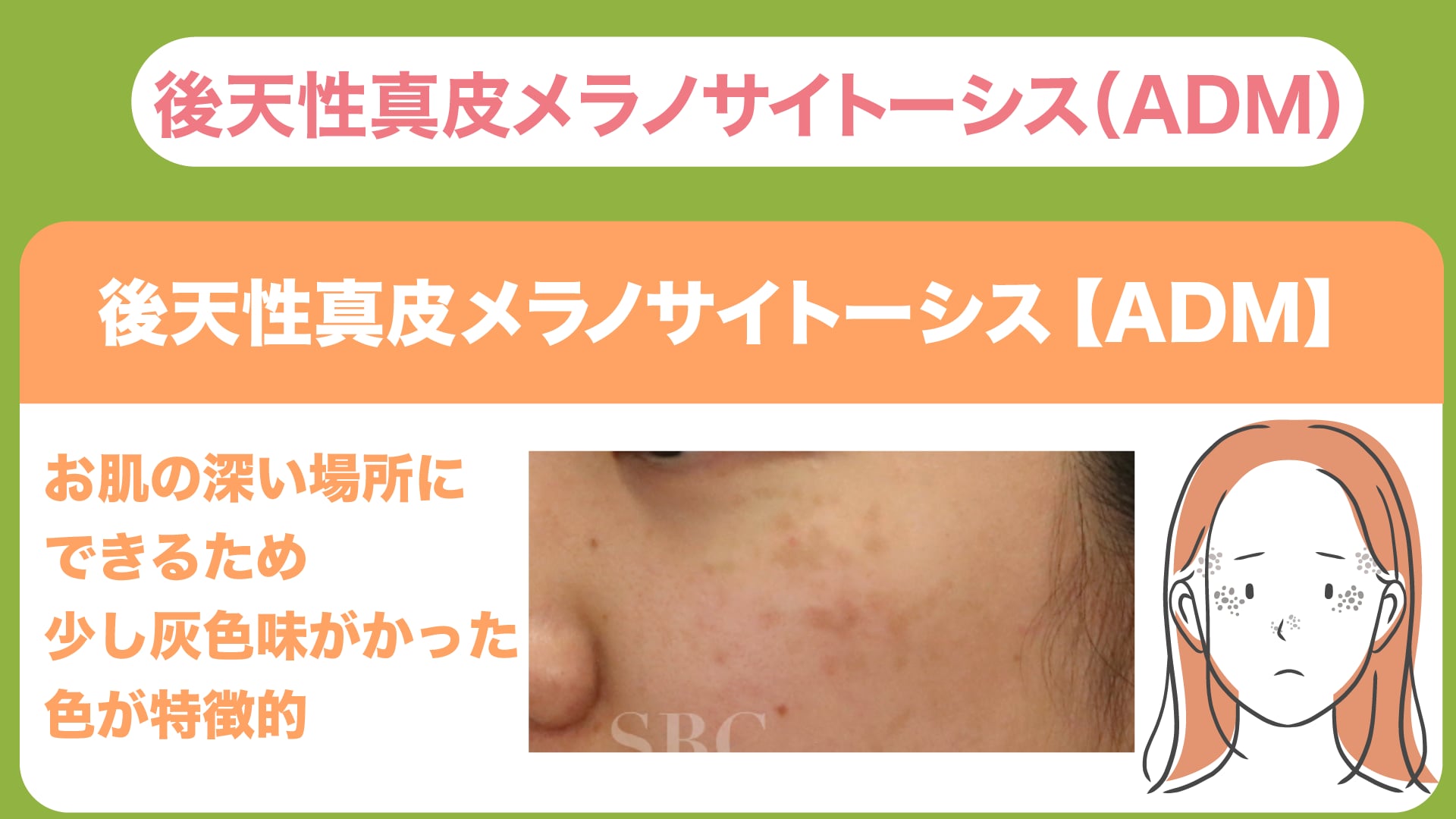 【後天性真皮メラノサイトーシス（ADM）】原因