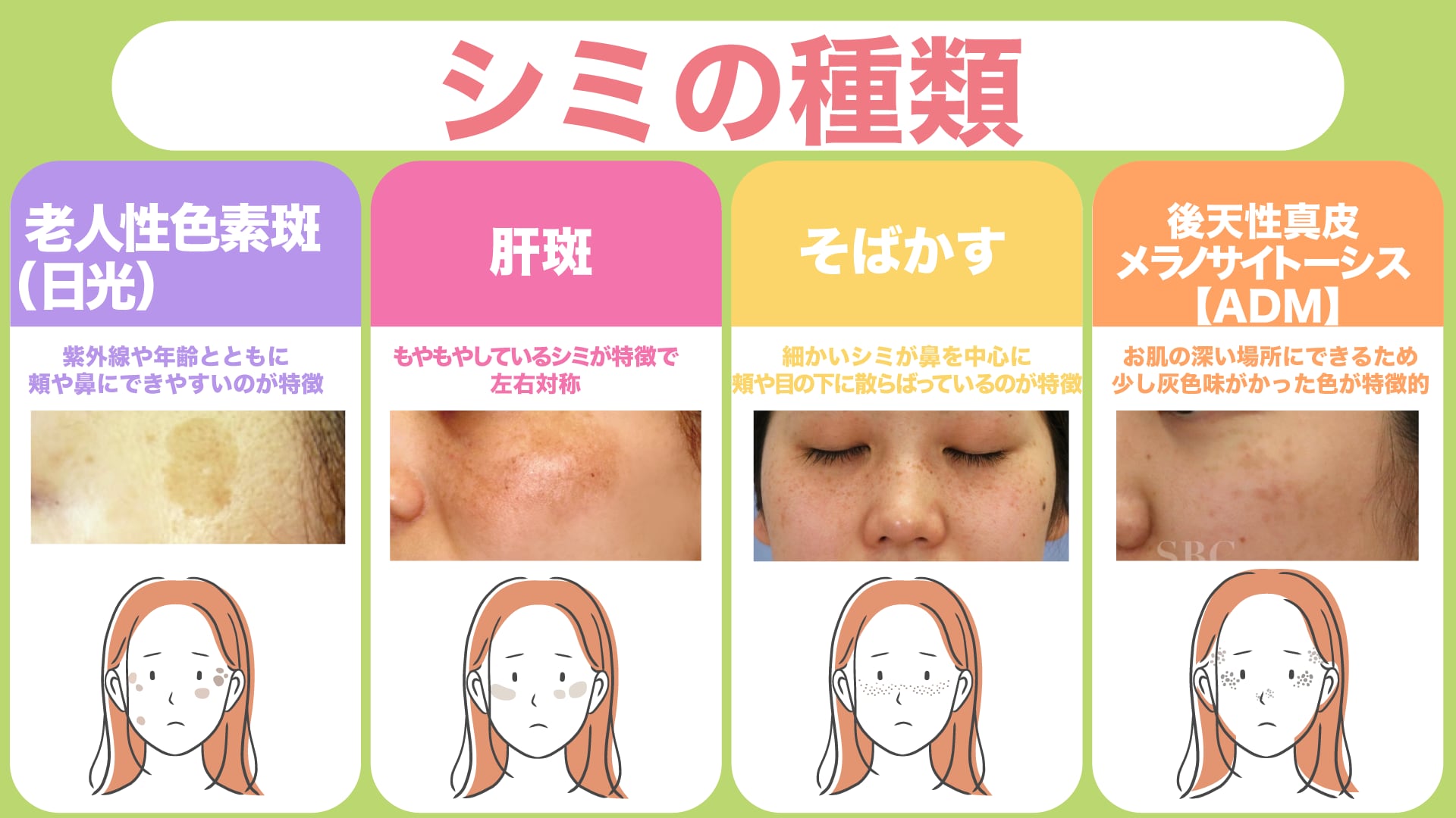 シミの種類