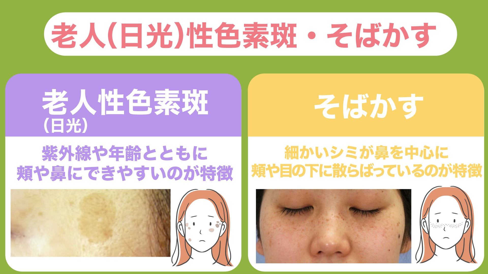 【日光性・老人性色素斑／そばかす】原因