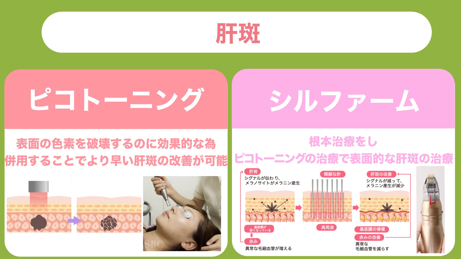 【肝斑】治療方法