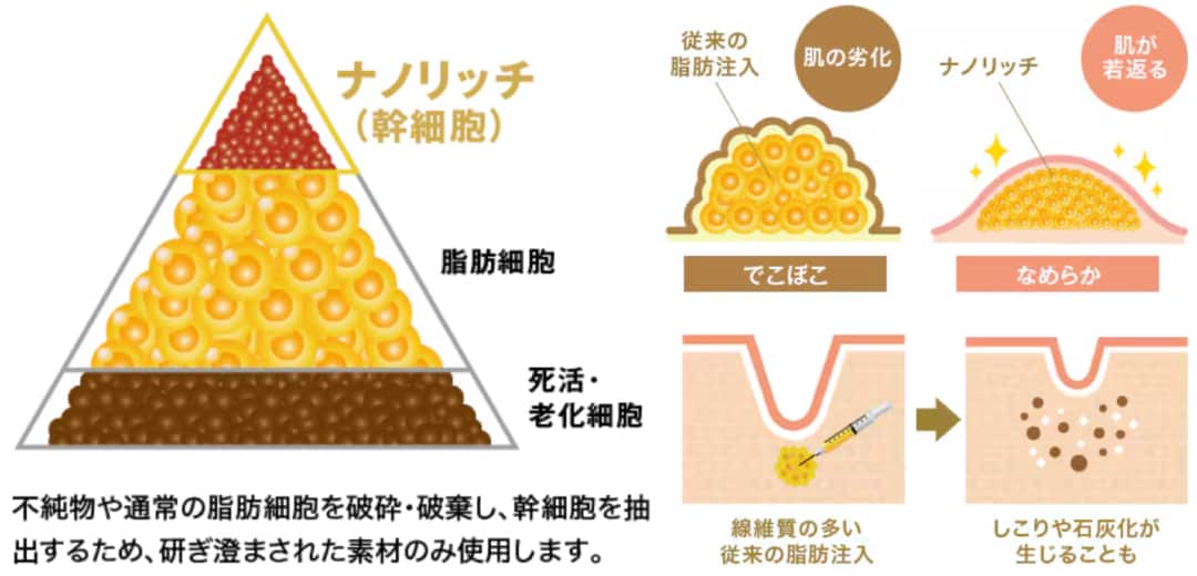 ナチュラル脂肪注射ナノリッチとは？