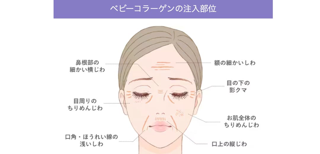 ダウンタイムが取れにくい方にお顔の若返り