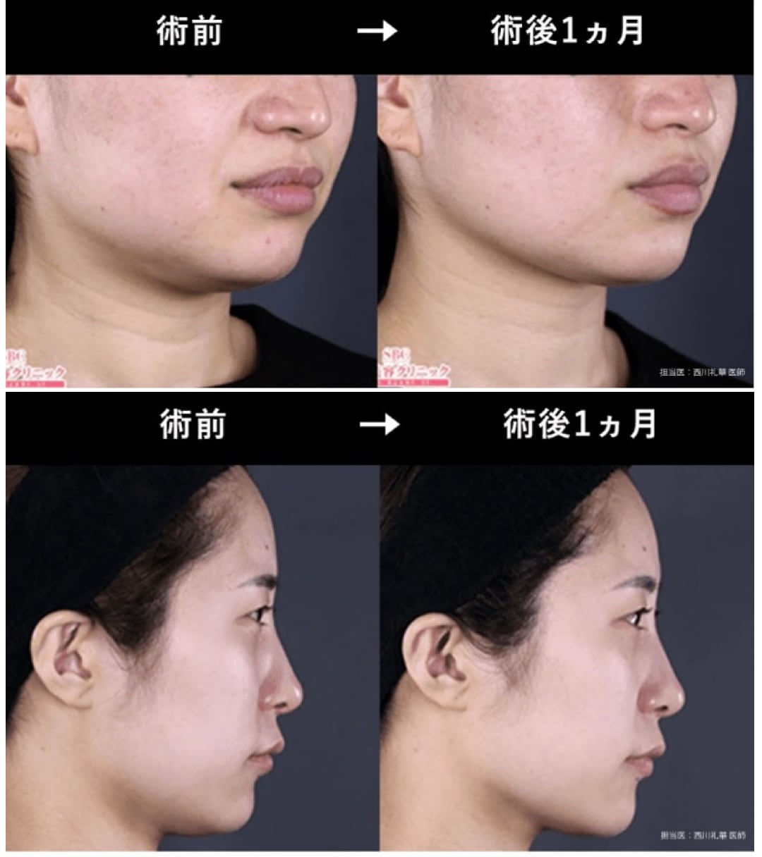 頬のもたつき・ほうれい線・あご下のたるみが気になり始めた方へ