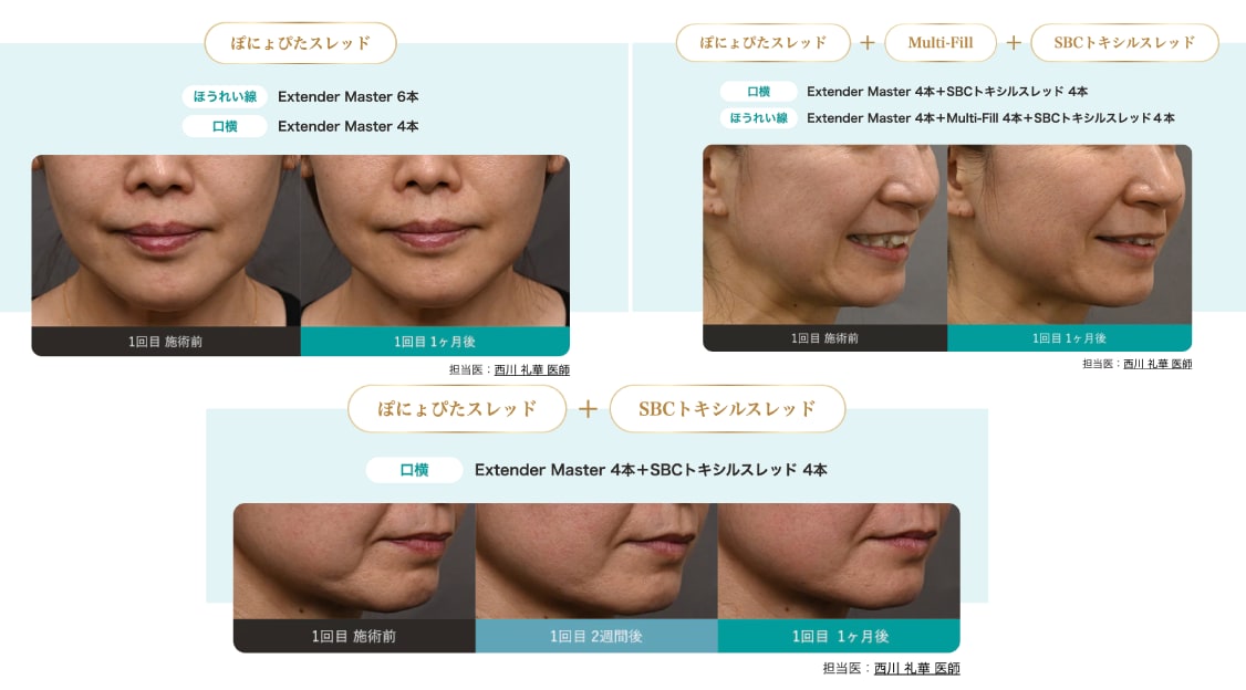 口元の印象で、ここまで若返る