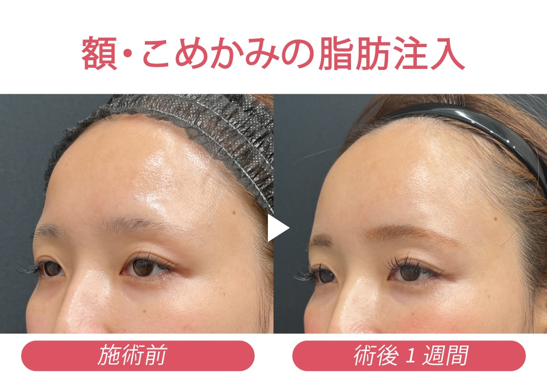 額・こめかみの脂肪注入