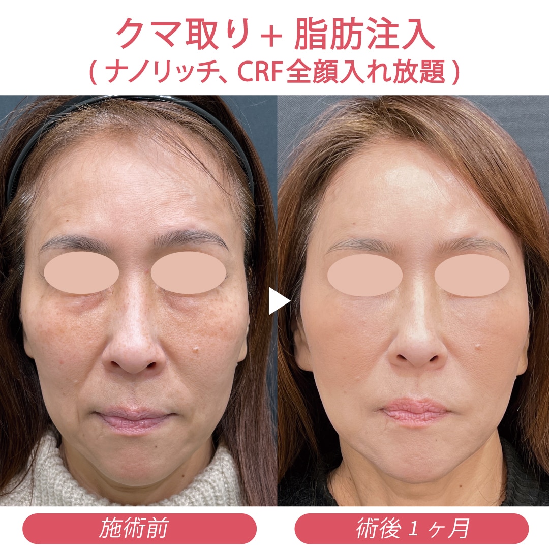 クマ取り+脂肪注入(ナノリッチ、コンデンスリッチ全顔入れ放題)
