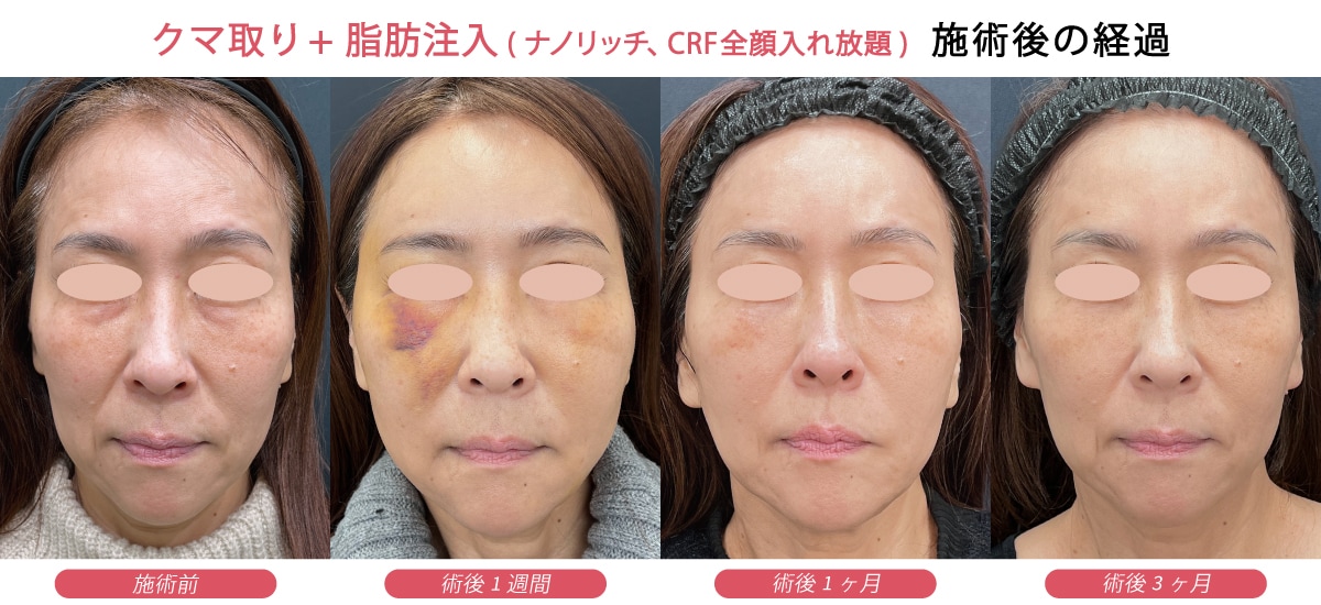 術後の経過やダウンタイムについて