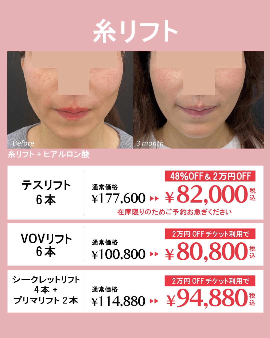 クリスマスまでにお得にたるみを改善!