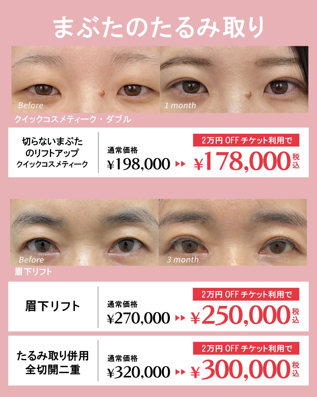 埋没法や切開法でまぶたのたるみを改善